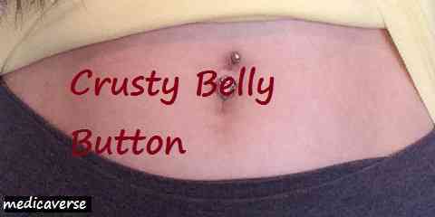 crusty belly button